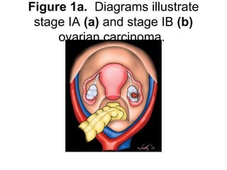 Figure 1a. Diagrams illustrate
stage IA (a) and stage IB (b)
ovarian carcinoma.
 