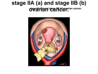stage IIA (a) and stage IIB (b)
ovarian cancer.
stage IIA (a) and stage IIB (b) ovarian cancer.
 