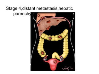 Stage 4,distant metastasis,hepatic
parenchyma
 