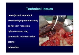 Extended resections
total
pancreatectomy

extended
lympadenectomy

portal vein and
SMA resection




                     ...