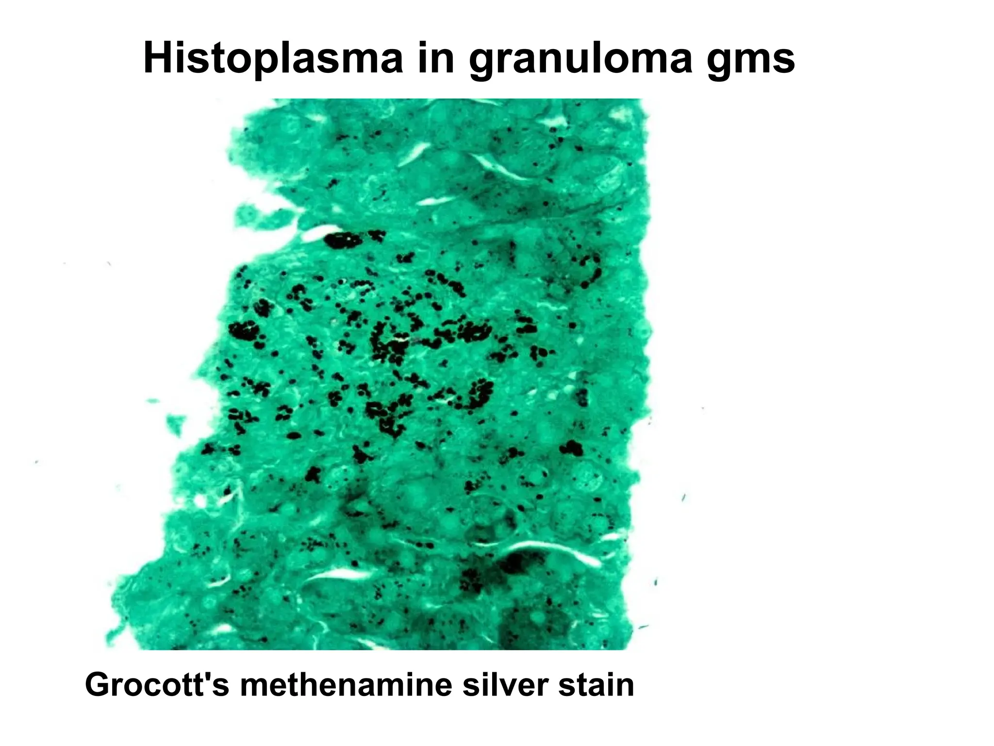 Histoplasma in granuloma gms
Grocott's methenamine silver stain
 