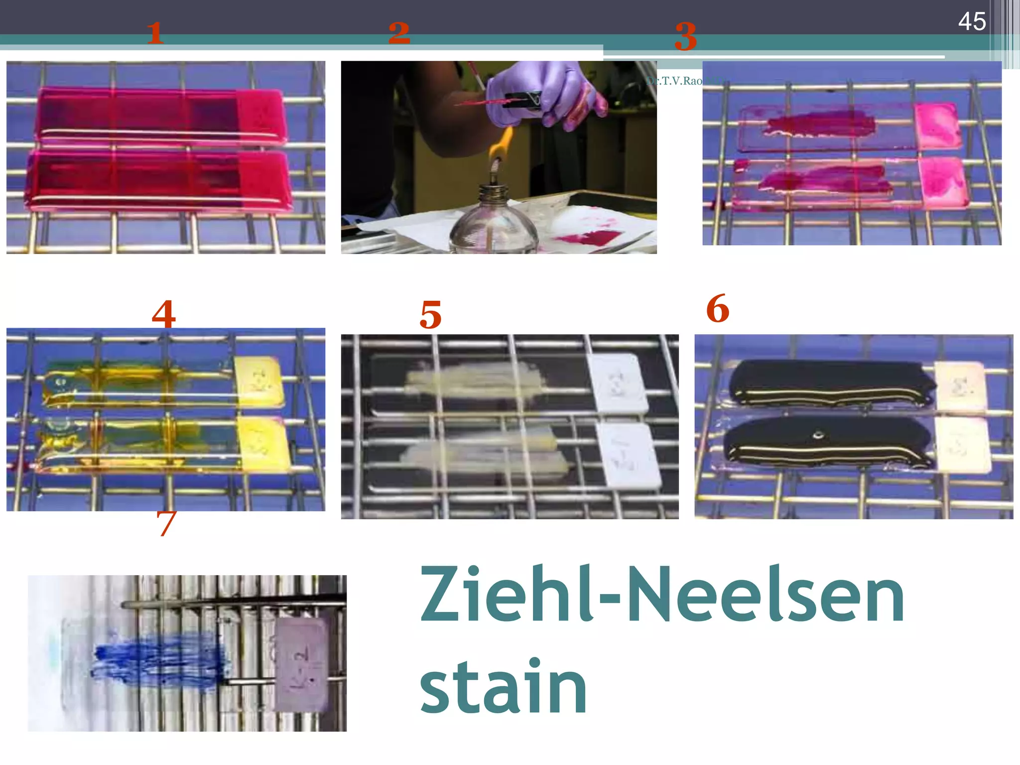 Ziehl-Neelsen
stain
4 5 6
7
1 2 3 45
Dr.T.V.Rao MD
 