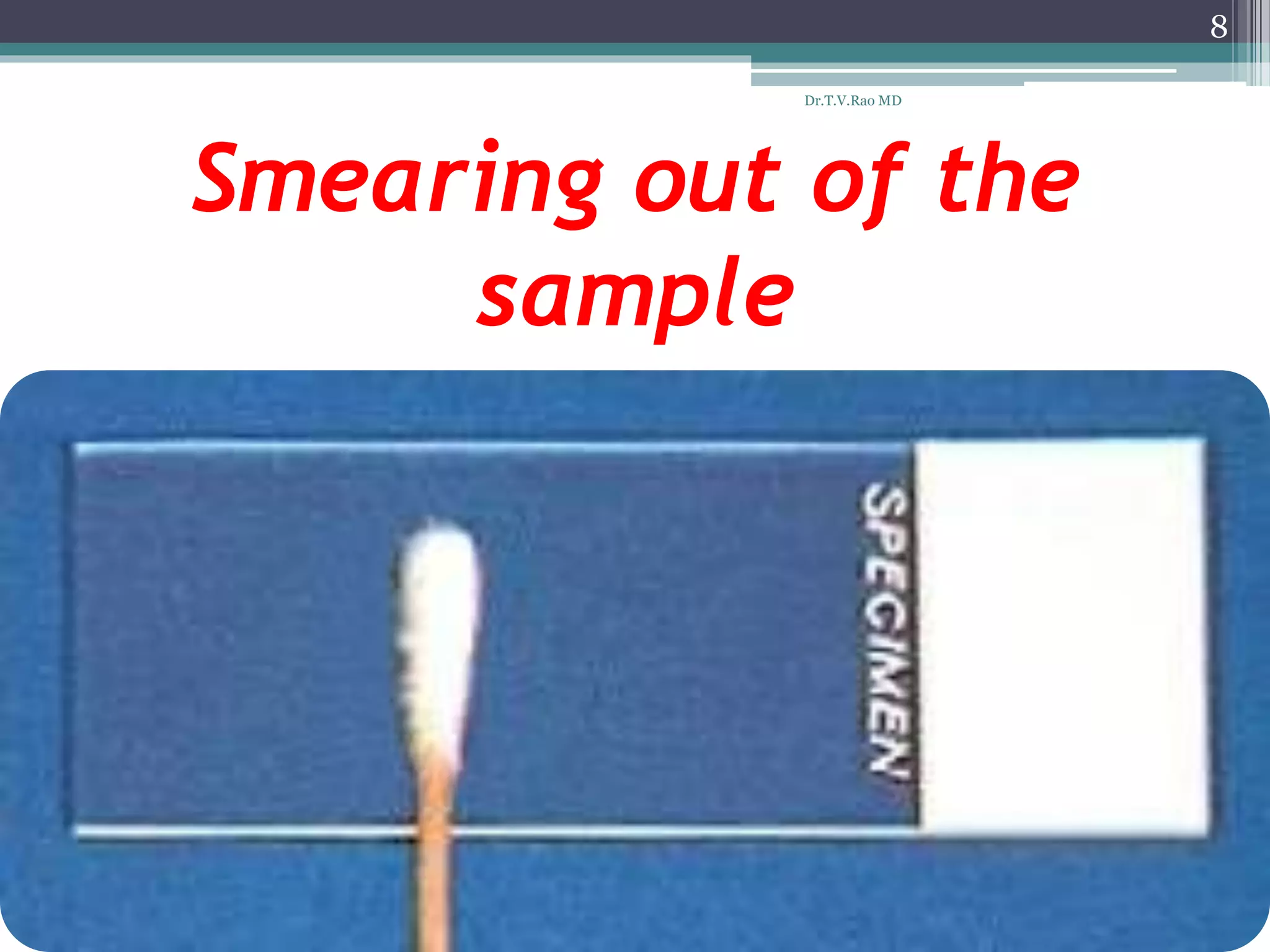 Smearing out of the
sample
8
Dr.T.V.Rao MD
 