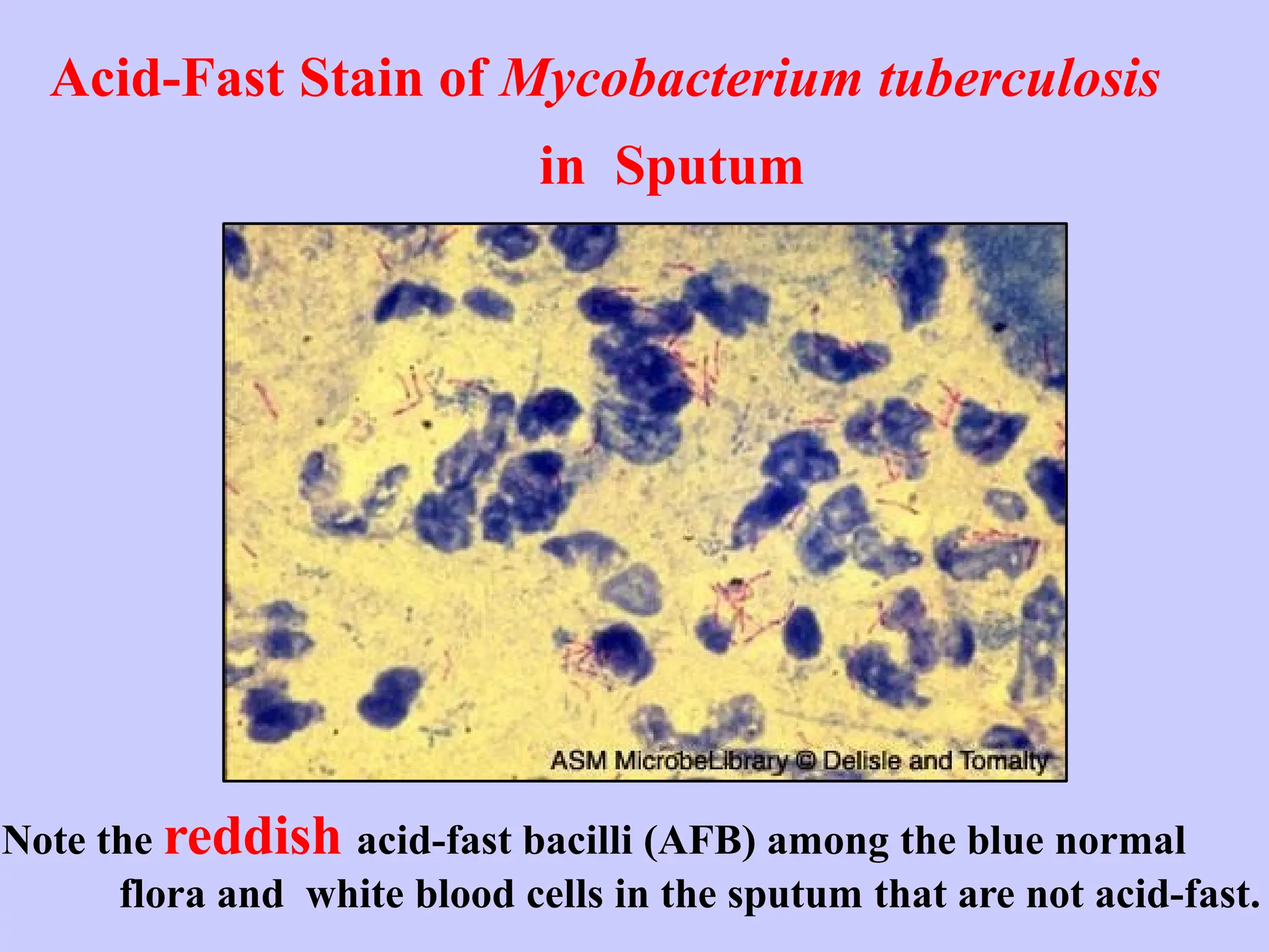 Acid-Fast Stain of Mycobacterium tuberculosis
in Sputum
Note the reddish acid-fast bacilli (AFB) among the blue normal
flora and white blood cells in the sputum that are not acid-fast.
 