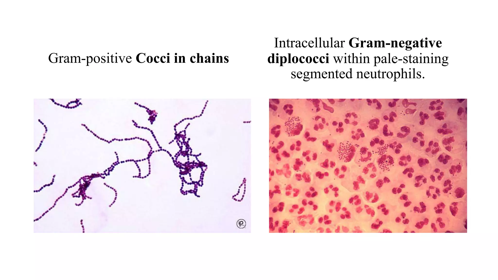 Gram-positive Cocci in chains
Intracellular Gram-negative
diplococci within pale-staining
segmented neutrophils.
 