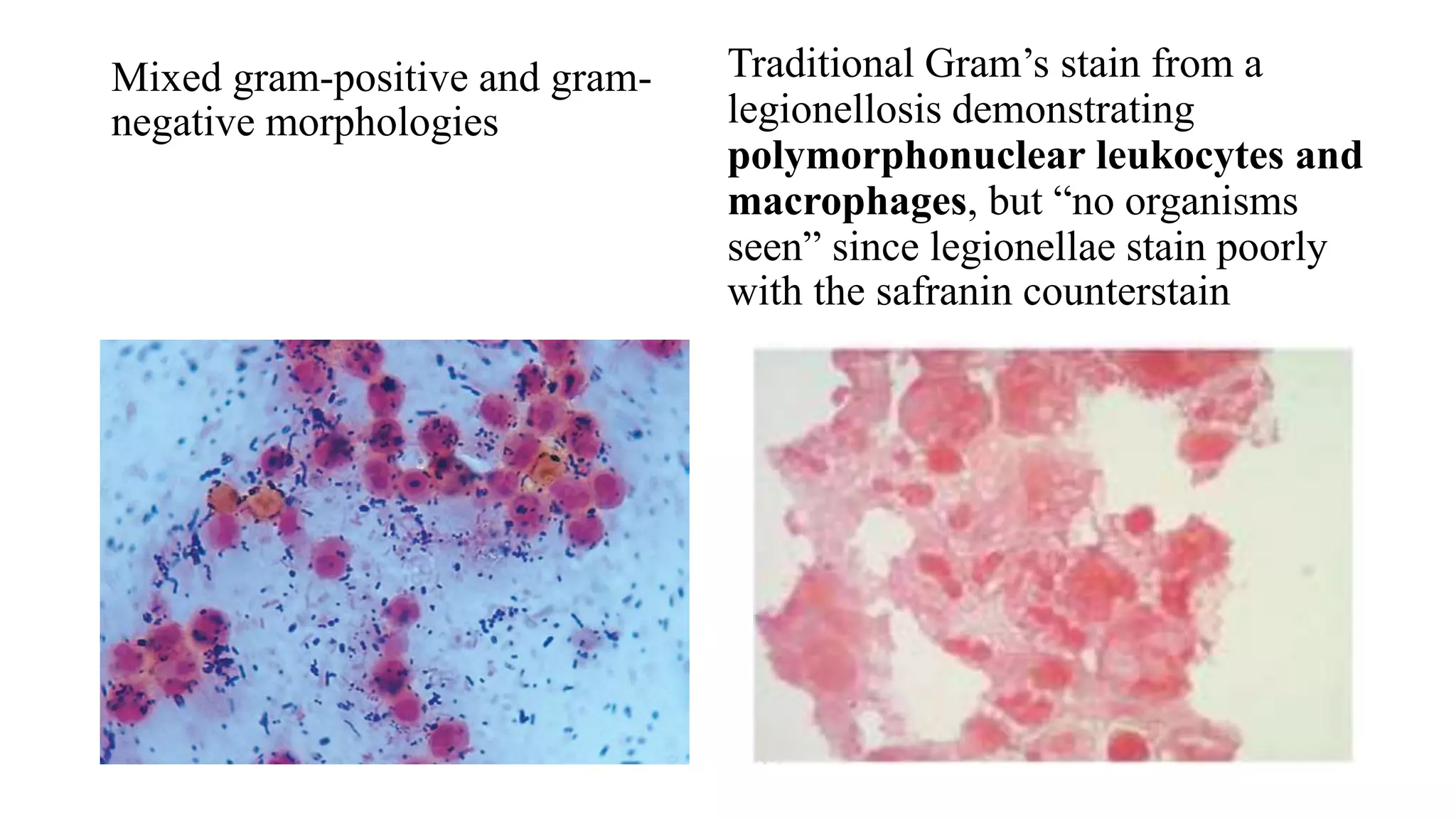 Mixed gram-positive and gram-
negative morphologies
Traditional Gram’s stain from a
legionellosis demonstrating
polymorphonuclear leukocytes and
macrophages, but “no organisms
seen” since legionellae stain poorly
with the safranin counterstain
 
