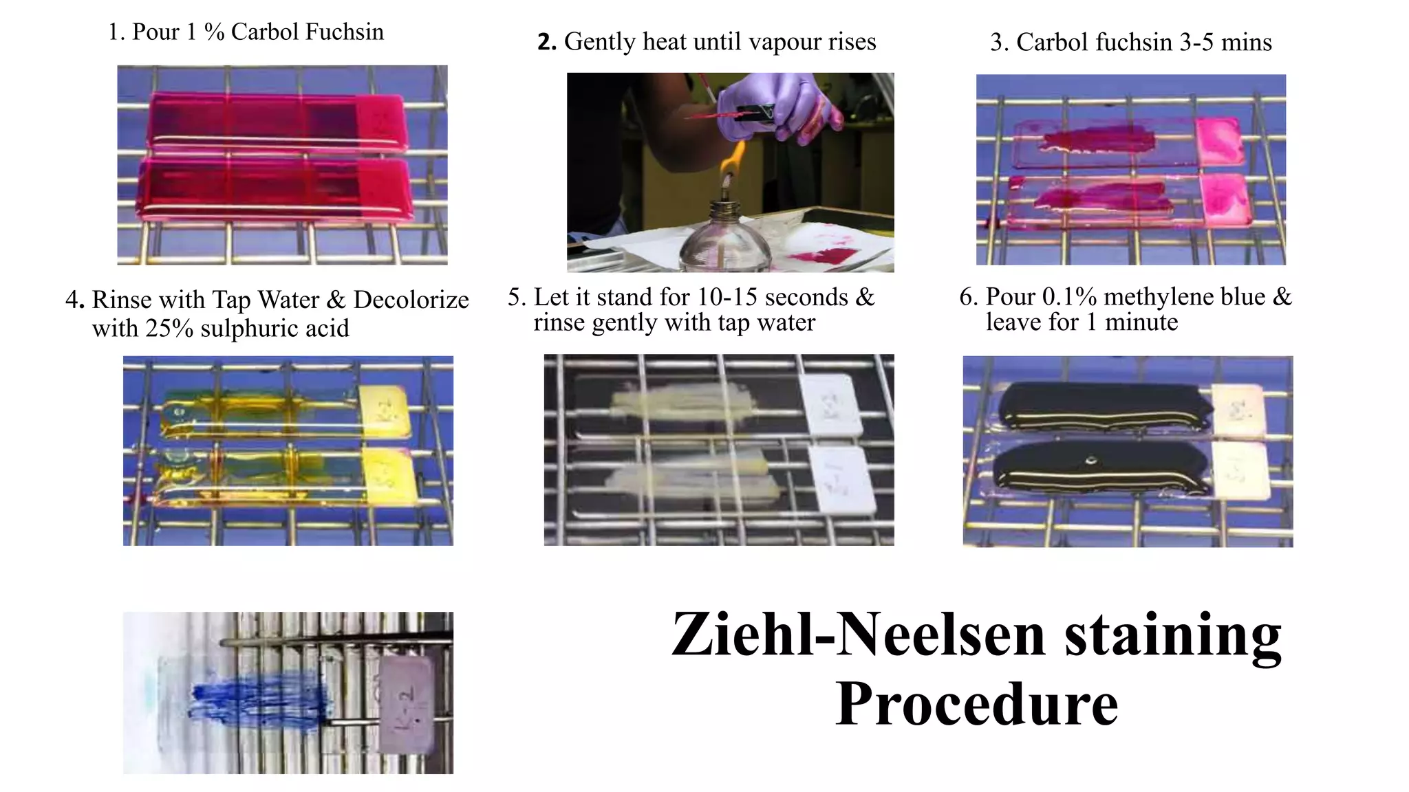 Ziehl-Neelsen staining
Procedure
4. Rinse with Tap Water & Decolorize
with 25% sulphuric acid
1. Pour 1 % Carbol Fuchsin
5. Let it stand for 10-15 seconds &
rinse gently with tap water
6. Pour 0.1% methylene blue &
leave for 1 minute
3. Carbol fuchsin 3-5 mins2. Gently heat until vapour rises
 
