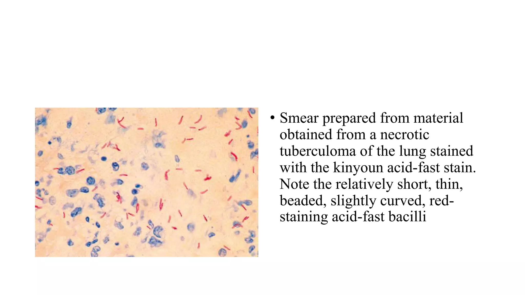 • Smear prepared from material
obtained from a necrotic
tuberculoma of the lung stained
with the kinyoun acid-fast stain.
Note the relatively short, thin,
beaded, slightly curved, red-
staining acid-fast bacilli
 