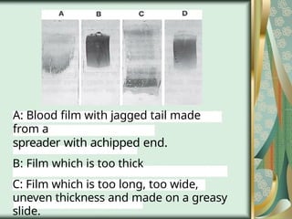 A: Blood film with jagged tail made
from a
spreader with achipped end.
B: Film which is too thick
C: Film which is too long, too wide,
uneven thickness and made on a greasy
slide.
 