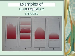 Examples of
unacceptable
smears
 
