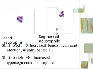 !
n
Band
neutrophii
Segmented
neutrophile
Shift to left Increased bands mean acuti
infection, usually bacterial.
Shift to right Increased
hypersegmented neutrophile.
 