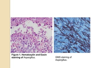 Figure 1. Hematoxylin and Eosin
staining of Aspergillus. GMS staining of
Aspergillus.
 