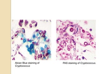 Alcian Blue staining of
Cryptococcus
PAS staining of Cryptococcus.
 