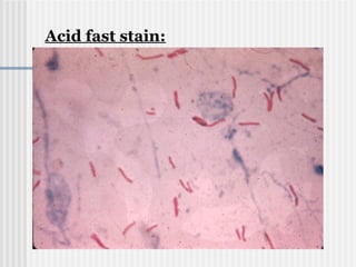Acid fast stain:
 