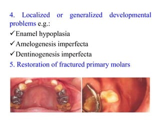 4. Localized or generalized developmental
problems e.g.:
Enamel hypoplasia
Amelogenesis imperfecta
Dentinogenesis imperfecta
5. Restoration of fractured primary molars
 