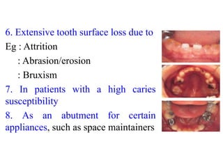 6. Extensive tooth surface loss due to
Eg : Attrition
: Abrasion/erosion
: Bruxism
7. In patients with a high caries
susceptibility
8. As an abutment for certain
appliances, such as space maintainers
 