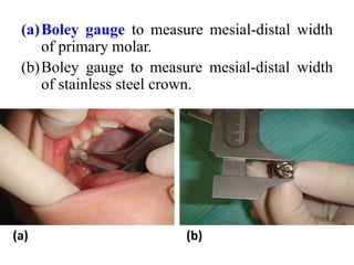 (a)Boley gauge to measure mesial-distal width
of primary molar.
(b)Boley gauge to measure mesial-distal width
of stainless steel crown.
(a) (b)
 