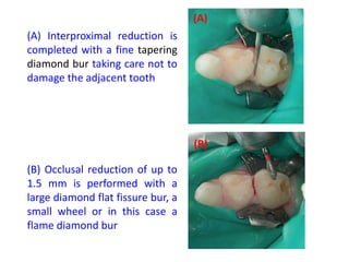 (A) Interproximal reduction is
completed with a fine tapering
diamond bur taking care not to
damage the adjacent tooth
(B) Occlusal reduction of up to
1.5 mm is performed with a
large diamond flat fissure bur, a
small wheel or in this case a
flame diamond bur
(A)
(B)
 