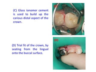 (C) Glass ionomer cement
is used to build up the
carious distal aspect of the
crown.
(D) Trial fit of the crown, by
seating from the lingual
onto the buccal surface.
(C)
(D)
 