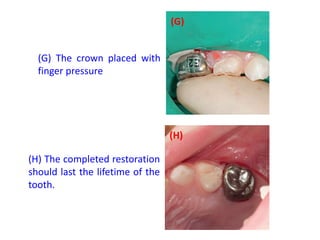 (G) The crown placed with
finger pressure
(H) The completed restoration
should last the lifetime of the
tooth.
(G)
(H)
 