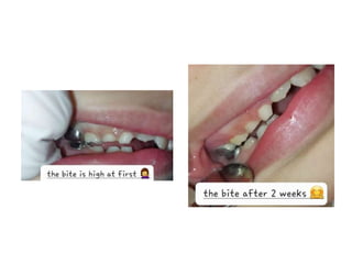 Stainless steel crown .pptx