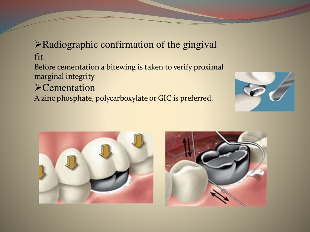 Stainless steel crowns