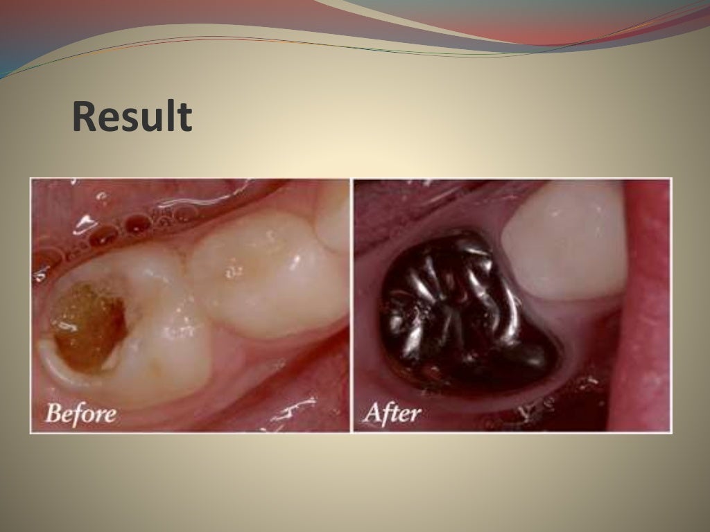 Stainless steel crowns