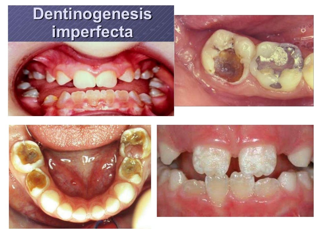 Stainless steel crowns in pediatric dentistry ppt