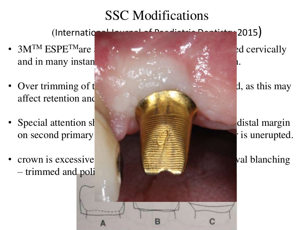 Stainless steel crowns in pediatric dentistry ppt