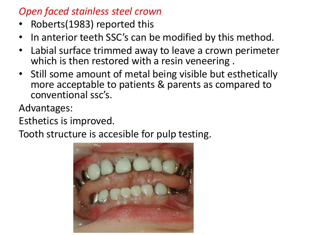 Stainless steel crowns in pediatric dentistry ppt