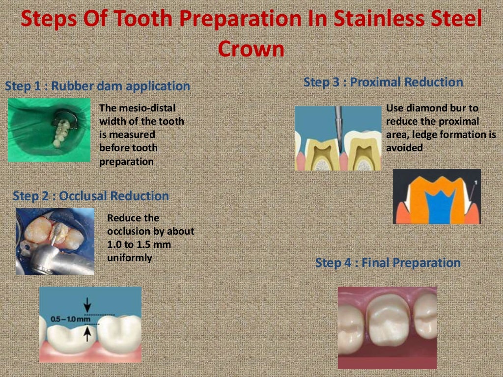 Stainless steel crowns (PEDODONTICS)