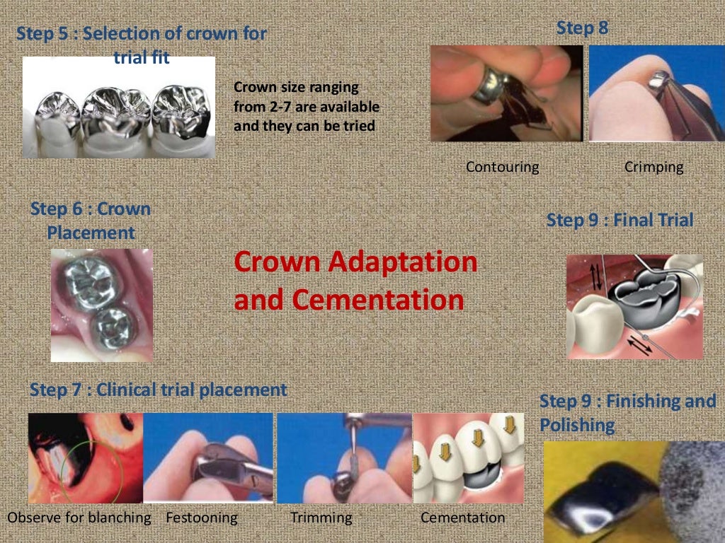 Stainless steel crowns (PEDODONTICS)