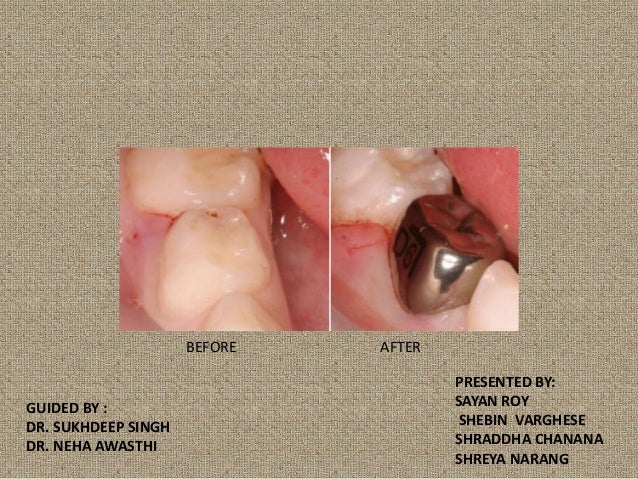 The Truth About Stainless Steel Crowns Experts Reveal All - qnnoscr