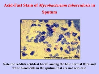 Acid-Fast Stain of Mycobacterium tuberculosis in
Sputum
Note the reddish acid-fast bacilli among the blue normal flora and
white blood cells in the sputum that are not acid-fast.
 