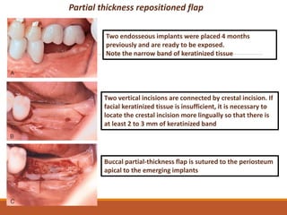 Standard implant surgical procedures | PPTX