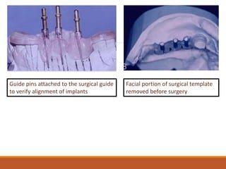 Standard implant surgical procedures | PPTX