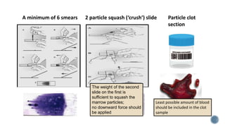 A minimum of 6 smears Particle clot
section
2 particle squash (‘crush’) slide
The weight of the second
slide on the first is
sufficient to squash the
marrow particles;
no downward force should
be applied
Least possible amount of blood
should be included in the clot
sample
 