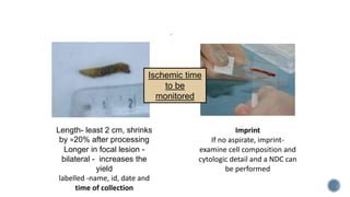 Imprint
If no aspirate, imprint-
examine cell composition and
cytologic detail and a NDC can
be performed
Length- least 2 cm, shrinks
by ≈20% after processing
Longer in focal lesion -
bilateral - increases the
yield
labelled -name, id, date and
time of collection
.
Ischemic time
to be
monitored
 
