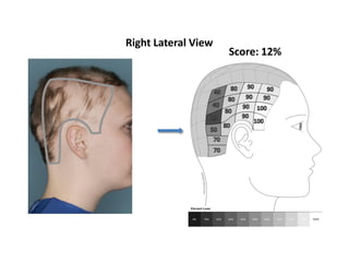 Standardizing Outcome Measures in Alopecia Areata | PDF