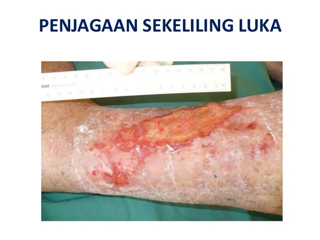 Standard operating procedure for wound dressing