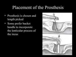 Stapes presentation | PPT
