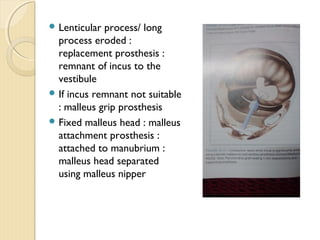 surgical management of ototsclerosis | PPT