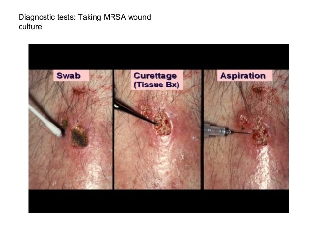 mrsa does not discriminate mrsa does not discriminate