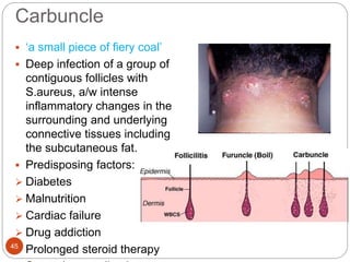 Staphylococcal & streptococcal skin infections | PPTX