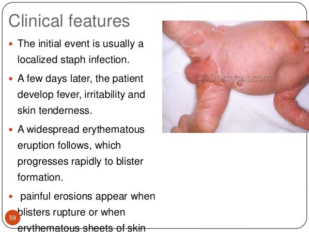 Staphylococcal & streptococcal skin infections Staphylococcal & streptococcal skin infections