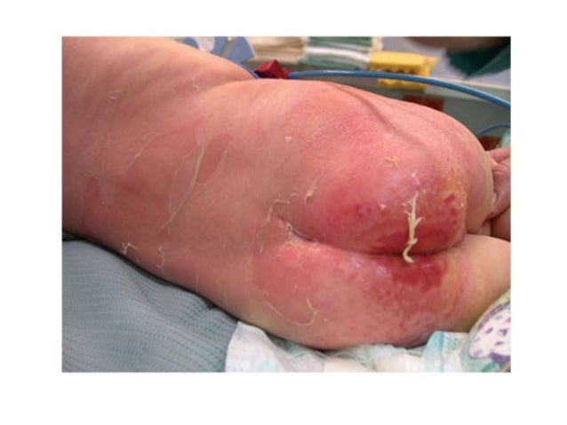 MSSA Infection -- Staph on Steroids