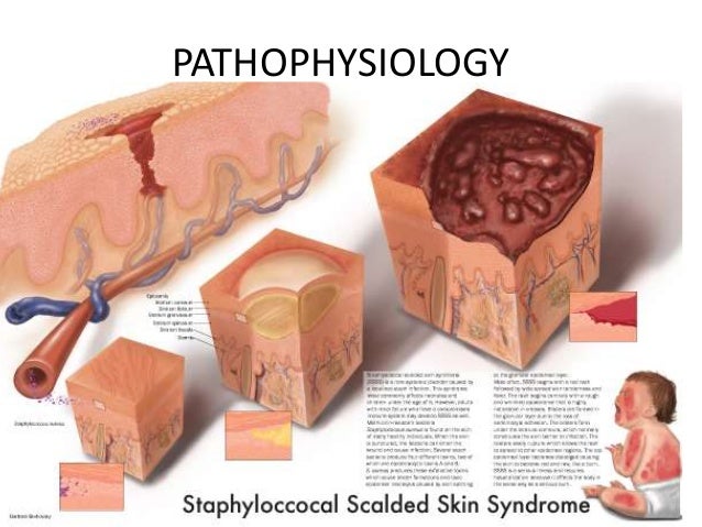 What Are the Symptoms of Toxic Shock Syndrome?