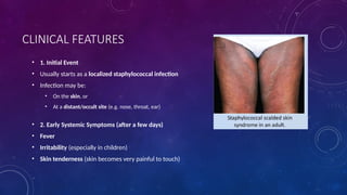 Sss Rash Comprehensive Overview of Staphylococcal Scalded Skin Syndrome (SSSS ...
