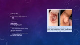 Sss Rash Comprehensive Overview of Staphylococcal Scalded Skin Syndrome (SSSS ...