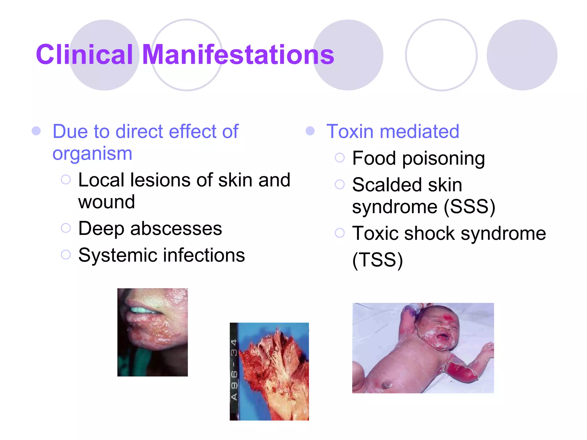 Clinical Manifestations Due to direct effect of organism Local lesions of skin and wound Deep abscesses Systemic infections Toxin mediated Food poisoning Scalded skin syndrome (SSS) Toxic shock syndrome (TSS) 